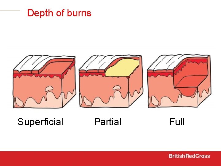 Depth of burns Superficial Partial Full 