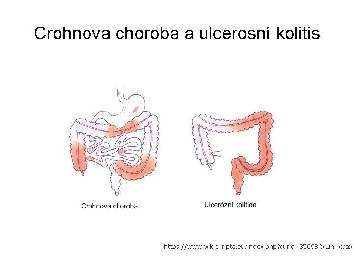 Crohnova choroba a ulcerosní kolitis https: //www. wikiskripta. eu/index. php? curid=35698">Link</a> 