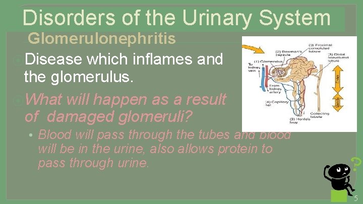 Disorders of the Urinary System Glomerulonephritis ⦿Disease which inflames and injures the glomerulus. ⦿What