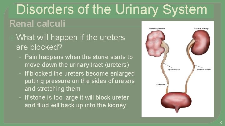 Disorders of the Urinary System Renal calculi ⦿ What will happen if the ureters Disorders of the Urinary System Renal calculi ⦿ What will happen if the ureters