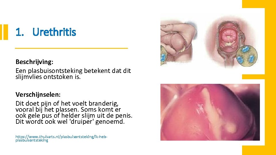 1. Urethritis Beschrijving: Een plasbuisontsteking betekent dat dit slijmvlies ontstoken is. Verschijnselen: Dit doet