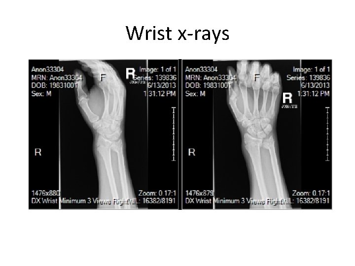 Wrist x-rays 