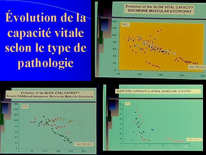 Évolution de la capacité vitale selon le type de pathologie 12 