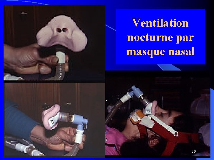 Ventilation nocturne par masque nasal 18 