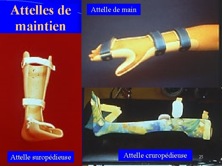 Attelles de maintien Attelle suropédieuse Attelle de main Attelle cruropédieuse 25 