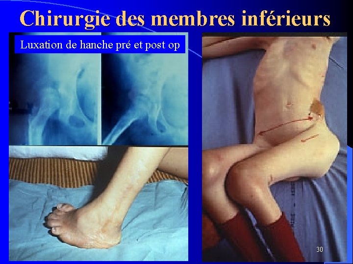 Chirurgie des membres inférieurs Luxation de hanche pré et post op 30 