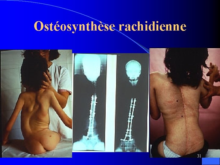 Ostéosynthèse rachidienne 31 
