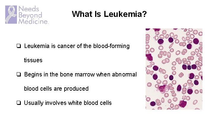 What Is Leukemia? ❏ Leukemia is cancer of the blood-forming tissues ❏ Begins in