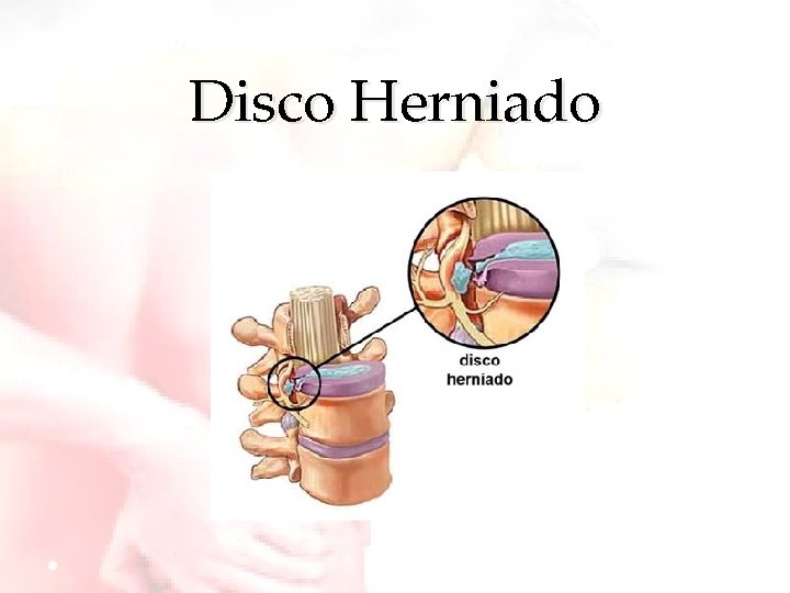 Disco Herniado 