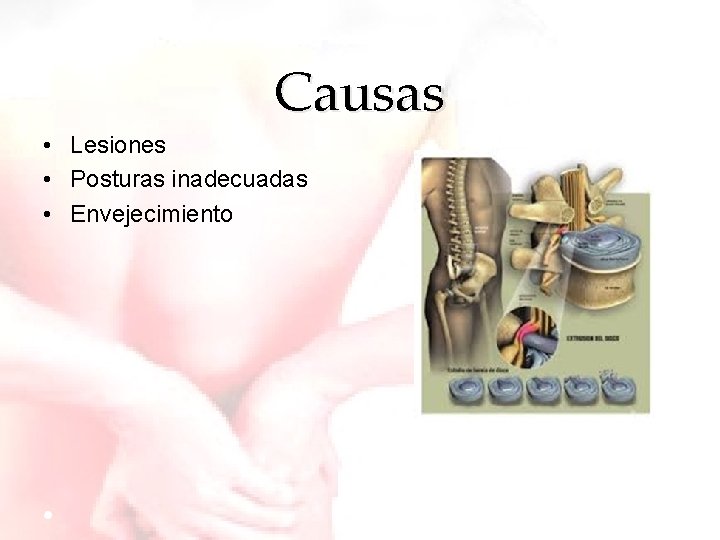 Causas • Lesiones • Posturas inadecuadas • Envejecimiento 