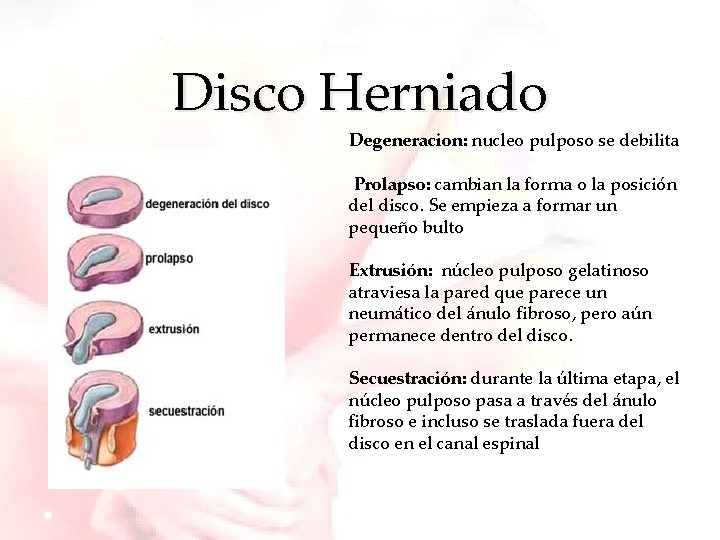 Disco Herniado Degeneracion: nucleo pulposo se debilita Prolapso: cambian la forma o la posición