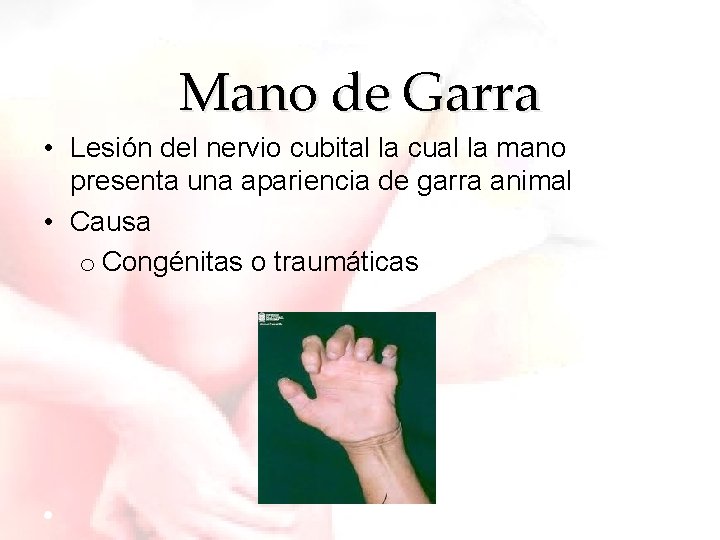 Mano de Garra • Lesión del nervio cubital la cual la mano presenta una