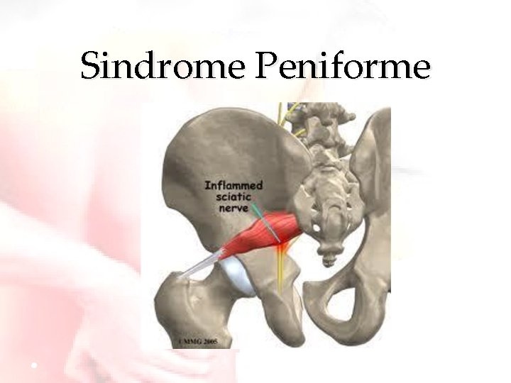 Sindrome Peniforme 