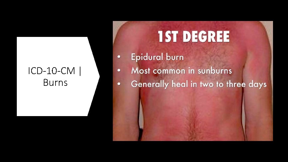 ICD-10 -CM | Burns 