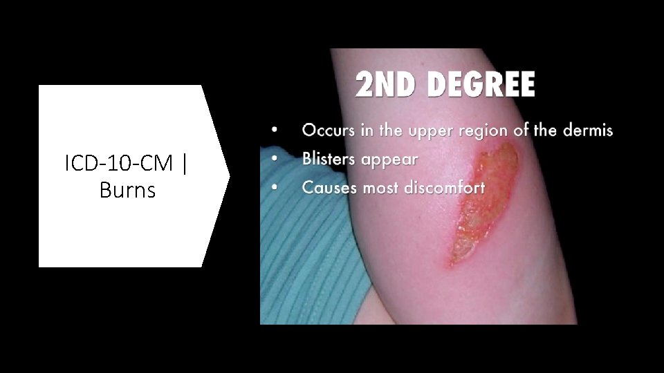 ICD-10 -CM | Burns 