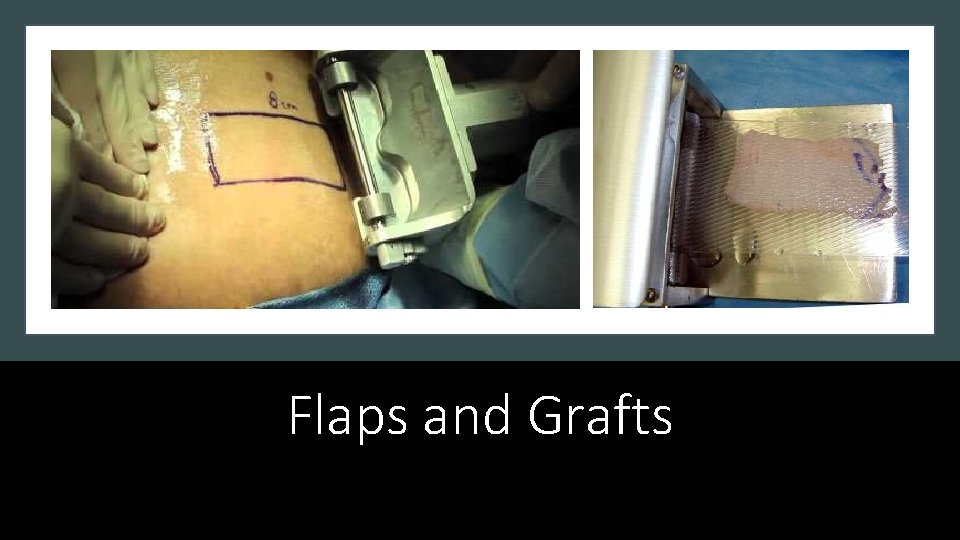Flaps and Grafts 