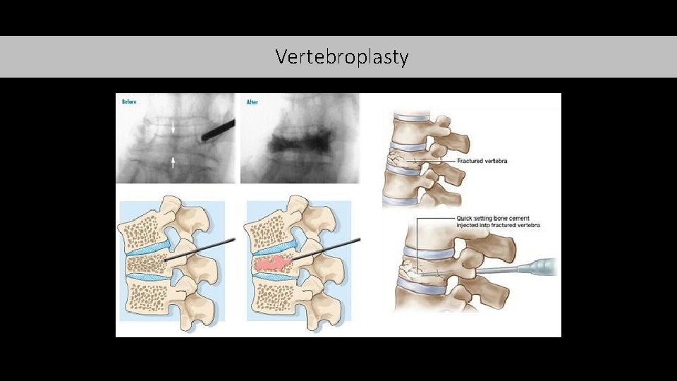 Vertebroplasty 