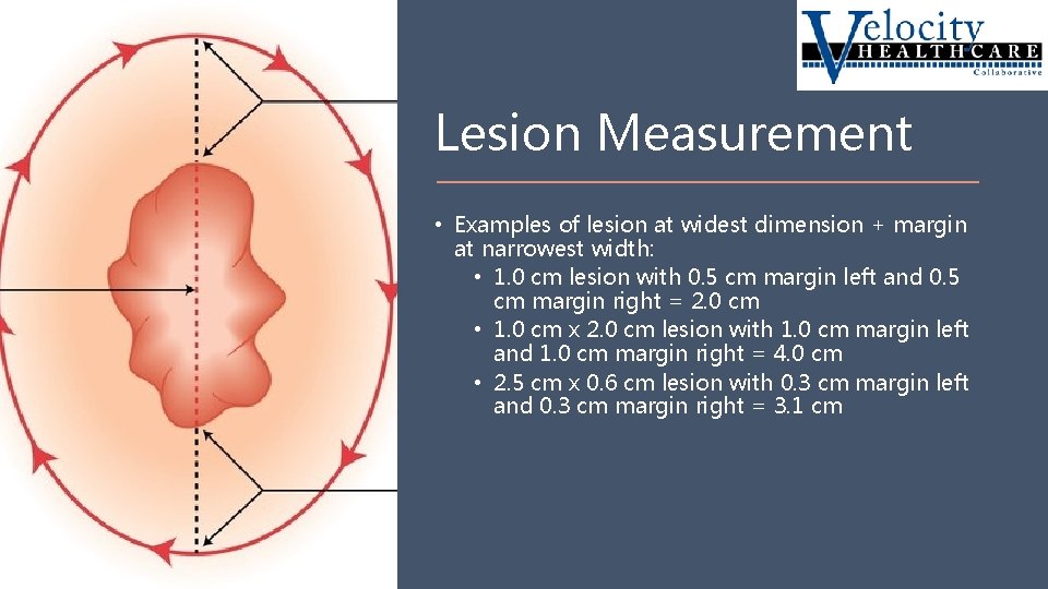 Lesion Measurement • Examples of lesion at widest dimension + margin at narrowest width: