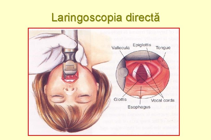 Laringoscopia directă 