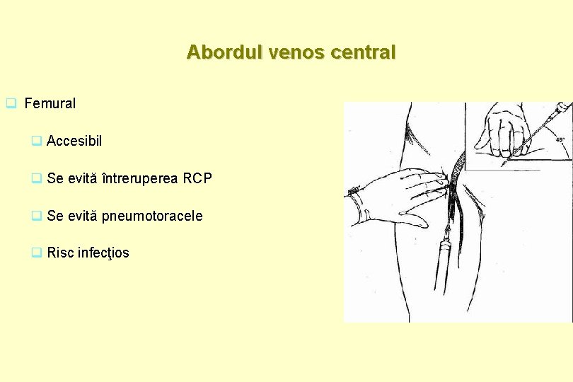 Abordul venos central q Femural q Accesibil q Se evită întreruperea RCP q Se