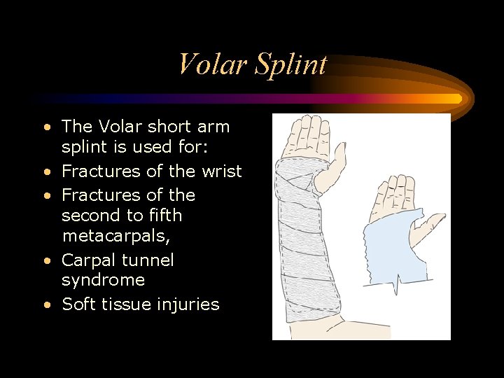 Volar Splint • The Volar short arm splint is used for: • Fractures of