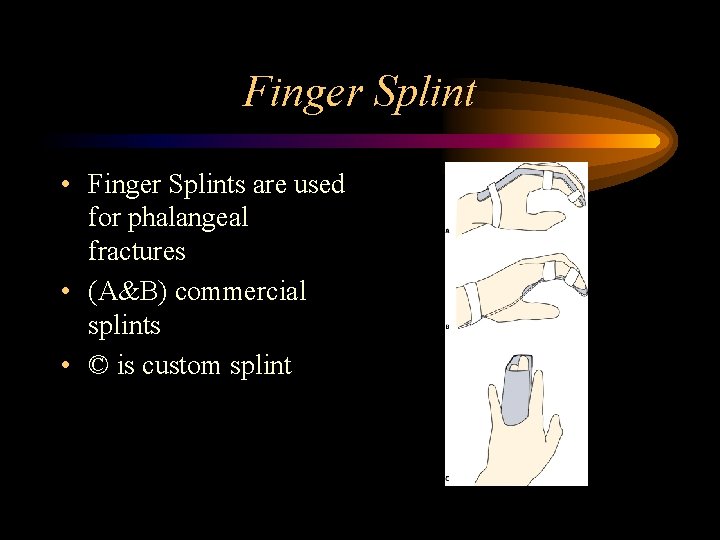 Finger Splint • Finger Splints are used for phalangeal fractures • (A&B) commercial splints