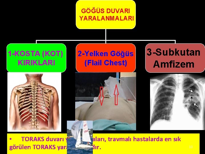 GÖĞÜS DUVARI YARALANMALARI 1 -KOSTA (KOT) KIRIKLARI 2 -Yelken Göğüs (Flail Chest) 3 -Subkutan GÖĞÜS DUVARI YARALANMALARI 1 -KOSTA (KOT) KIRIKLARI 2 -Yelken Göğüs (Flail Chest) 3 -Subkutan
