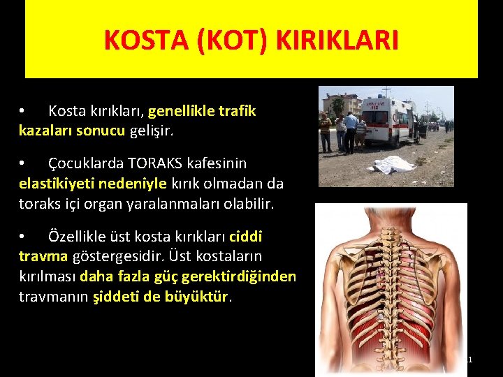 KOSTA (KOT) KIRIKLARI • Kosta kırıkları, genellikle trafik kazaları sonucu gelişir. • Çocuklarda TORAKS KOSTA (KOT) KIRIKLARI • Kosta kırıkları, genellikle trafik kazaları sonucu gelişir. • Çocuklarda TORAKS