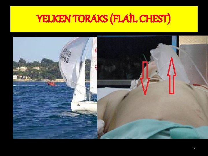YELKEN TORAKS (FLAİL CHEST) 13 YELKEN TORAKS (FLAİL CHEST) 13