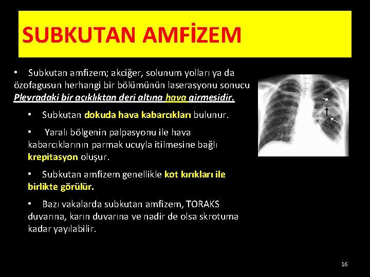 SUBKUTAN AMFİZEM • Subkutan amfizem; akciğer, solunum yolları ya da özofagusun herhangi bir bölümünün SUBKUTAN AMFİZEM • Subkutan amfizem; akciğer, solunum yolları ya da özofagusun herhangi bir bölümünün