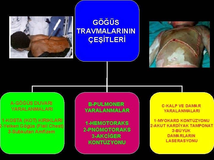 GÖĞÜS TRAVMALARININ ÇEŞİTLERİ A-GÖĞÜS DUVARI YARALANMALARI 1 -KOSTA (KOT) KIRIKLARI 2 -Yelken Göğüs (Flail GÖĞÜS TRAVMALARININ ÇEŞİTLERİ A-GÖĞÜS DUVARI YARALANMALARI 1 -KOSTA (KOT) KIRIKLARI 2 -Yelken Göğüs (Flail