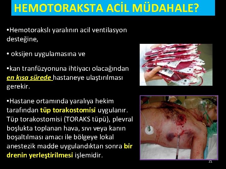 HEMOTORAKSTA ACİL MÜDAHALE? • Hemotorakslı yaralının acil ventilasyon desteğine, • oksijen uygulamasına ve • HEMOTORAKSTA ACİL MÜDAHALE? • Hemotorakslı yaralının acil ventilasyon desteğine, • oksijen uygulamasına ve •