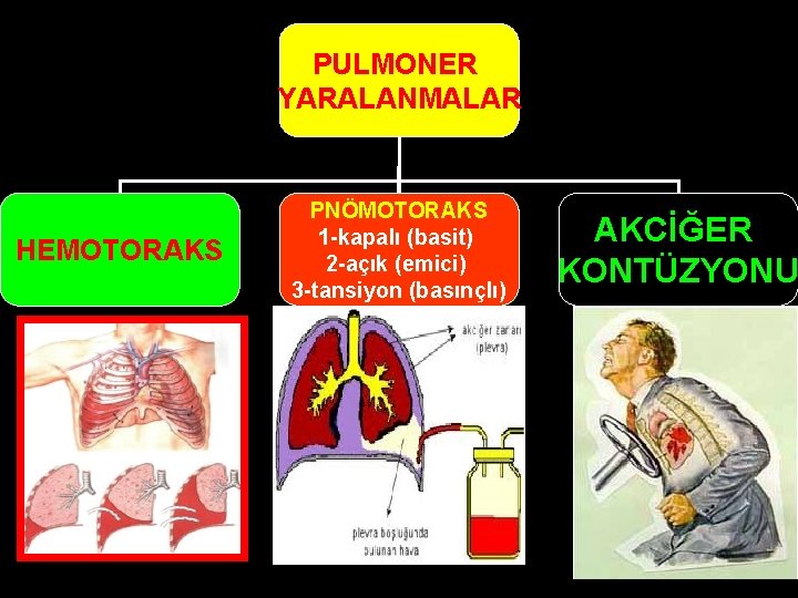 PULMONER YARALANMALAR HEMOTORAKS PNÖMOTORAKS 1 -kapalı (basit) 2 -açık (emici) 3 -tansiyon (basınçlı) AKCİĞER PULMONER YARALANMALAR HEMOTORAKS PNÖMOTORAKS 1 -kapalı (basit) 2 -açık (emici) 3 -tansiyon (basınçlı) AKCİĞER
