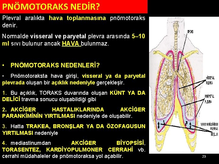 PNÖMOTORAKS NEDİR? Plevral aralıkta hava toplanmasına pnömotoraks denir. Normalde visseral ve paryetal plevra arasında PNÖMOTORAKS NEDİR? Plevral aralıkta hava toplanmasına pnömotoraks denir. Normalde visseral ve paryetal plevra arasında