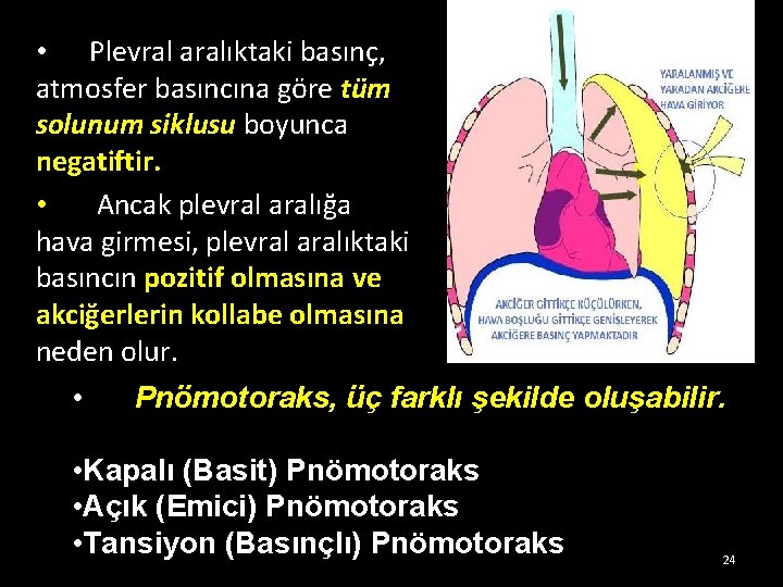 • Plevral aralıktaki basınç, atmosfer basıncına göre tüm solunum siklusu boyunca negatiftir. • • Plevral aralıktaki basınç, atmosfer basıncına göre tüm solunum siklusu boyunca negatiftir. •