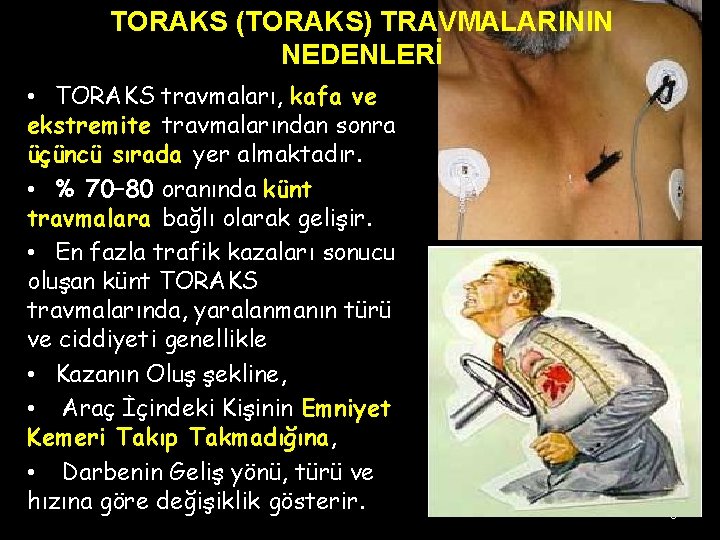 TORAKS (TORAKS) TRAVMALARININ NEDENLERİ • TORAKS travmaları, kafa ve ekstremite travmalarından sonra üçüncü sırada TORAKS (TORAKS) TRAVMALARININ NEDENLERİ • TORAKS travmaları, kafa ve ekstremite travmalarından sonra üçüncü sırada