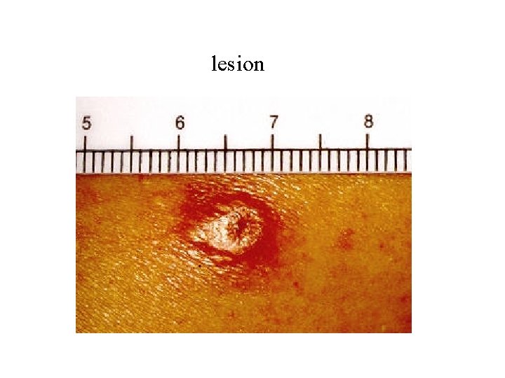 lesion 