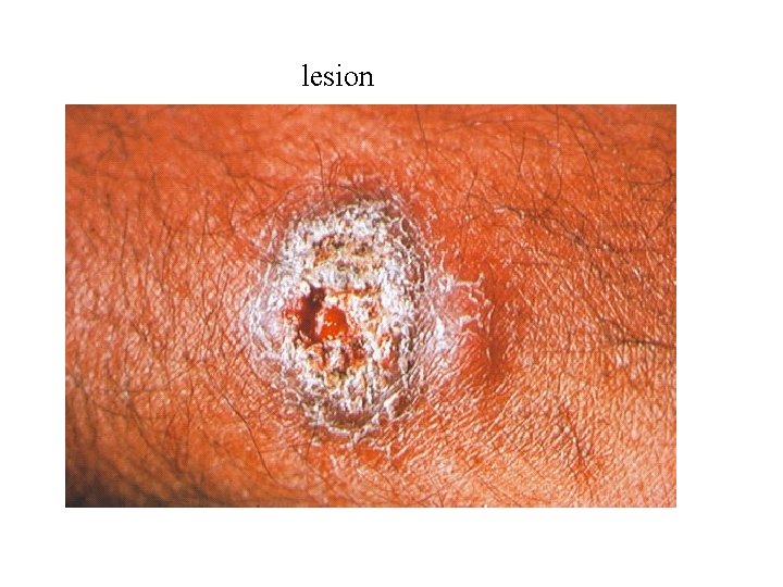 lesion 