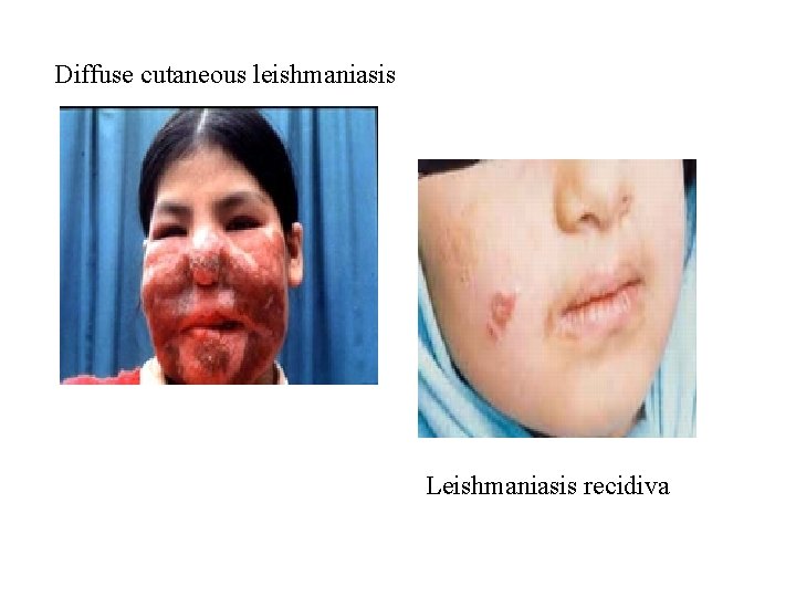 Diffuse cutaneous leishmaniasis Leishmaniasis recidiva 