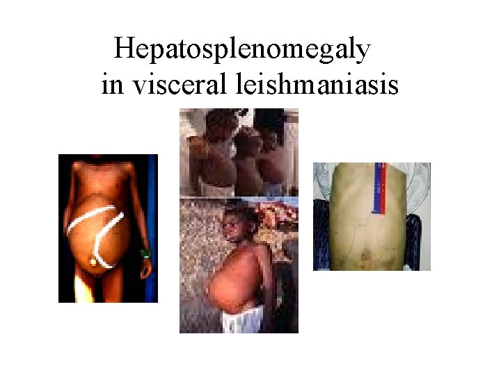Hepatosplenomegaly in visceral leishmaniasis 