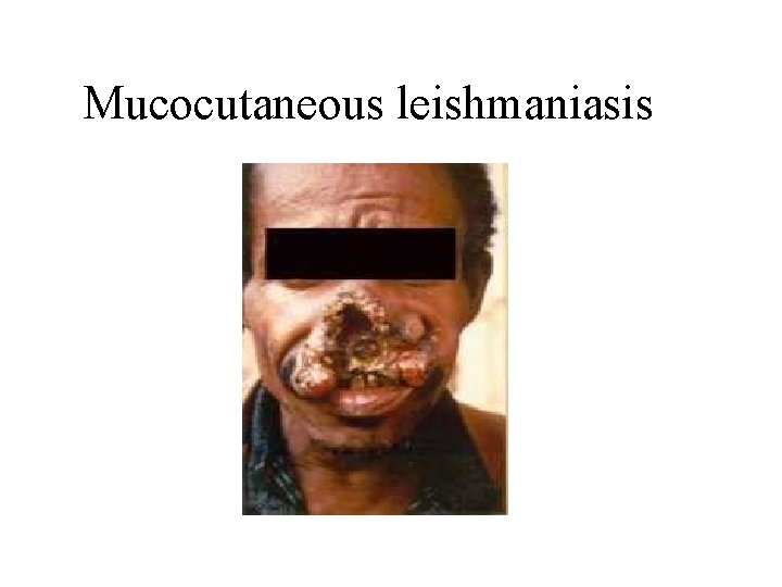 Mucocutaneous leishmaniasis 