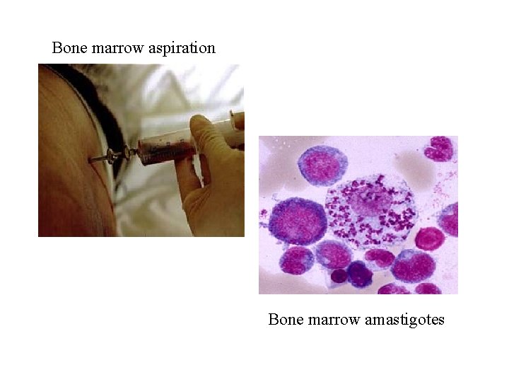 Bone marrow aspiration Bone marrow amastigotes 