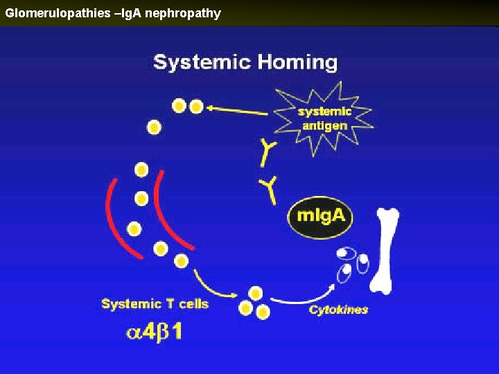 Glomerulopathies –Ig. A nephropathy 