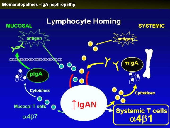 Glomerulopathies –Ig. A nephropathy 