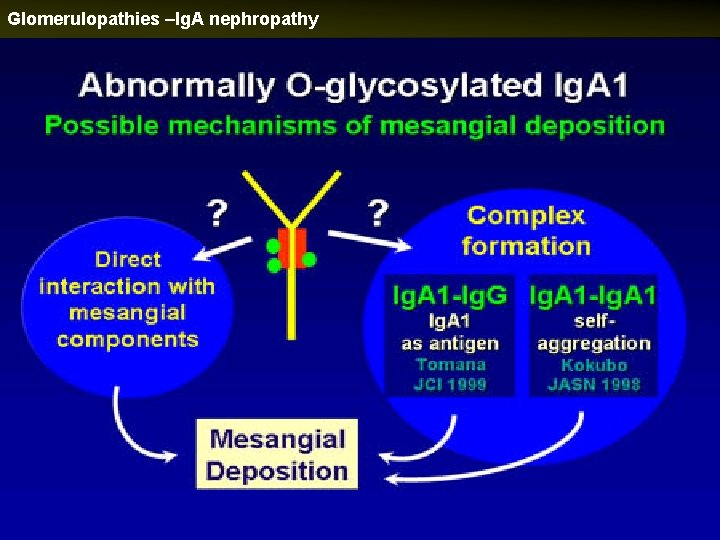 Glomerulopathies –Ig. A nephropathy 
