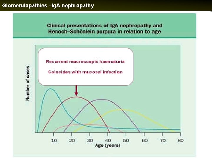 Glomerulopathies –Ig. A nephropathy 