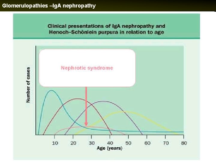 Glomerulopathies –Ig. A nephropathy 