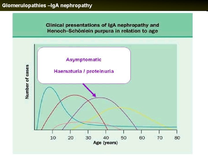 Glomerulopathies –Ig. A nephropathy 