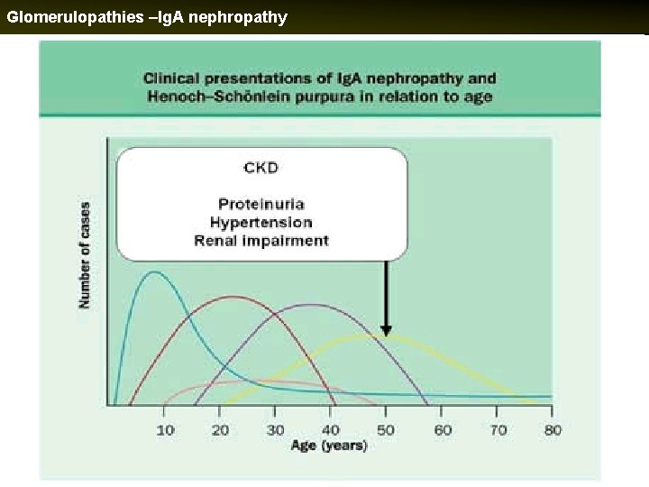 Glomerulopathies –Ig. A nephropathy 