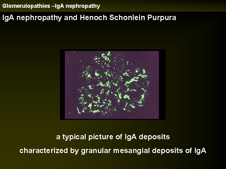 Glomerulopathies –Ig. A nephropathy and Henoch Schonlein Purpura a typical picture of Ig. A